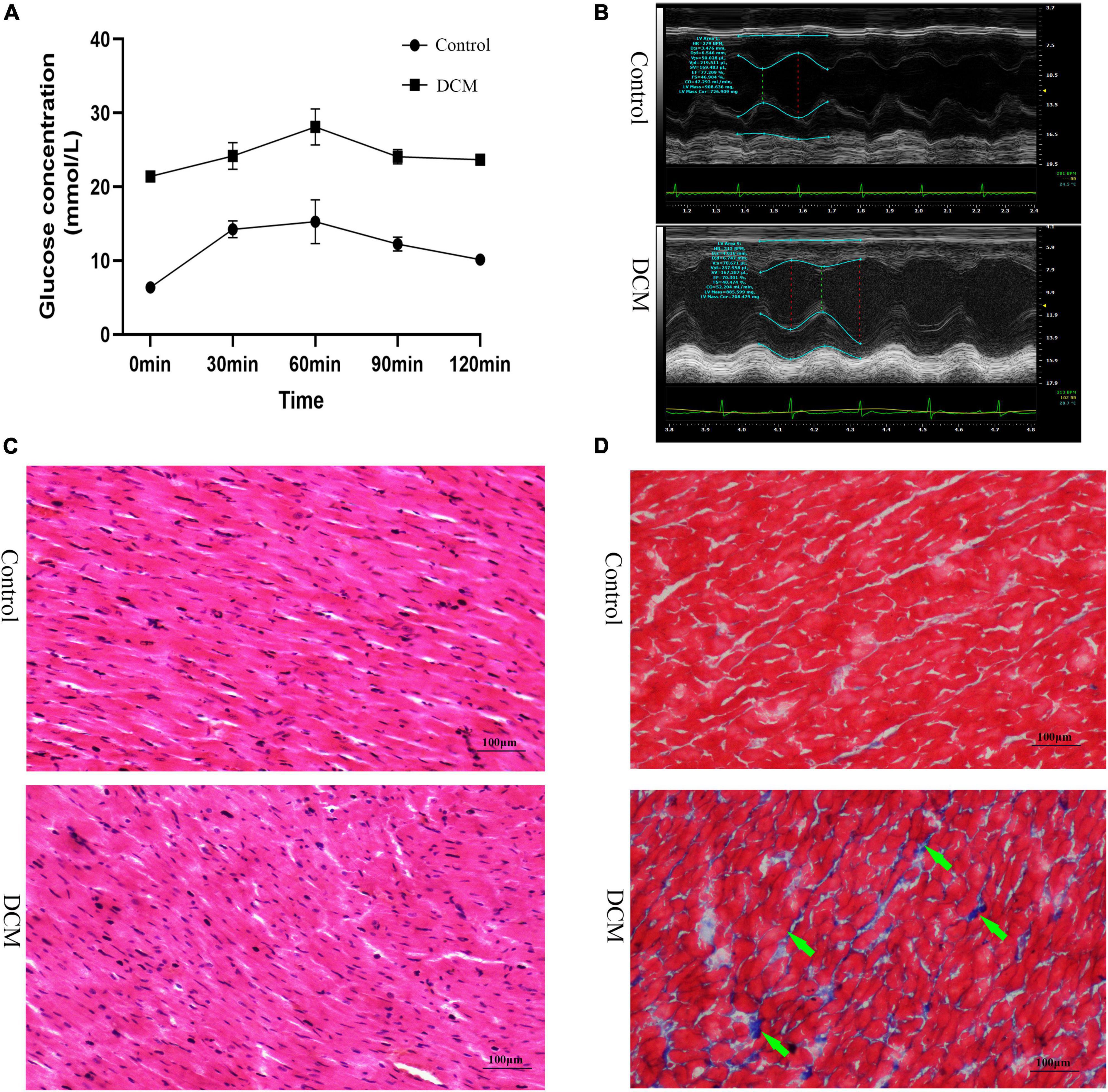 Proteome-wide analysis of lysine β-hydroxybutyrylation in the myocardium of diabetic rat model with cardiomyopathy